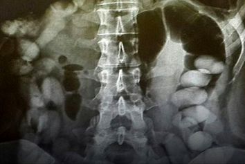 کشف ۷۷ بسته کوکائین
 ۵ میلیاردی از شکم مسافر در فرودگاه امام