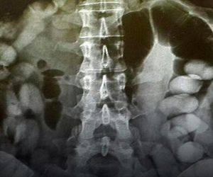 کشف ۷۷ بسته کوکائین
 ۵ میلیاردی از شکم مسافر در فرودگاه امام